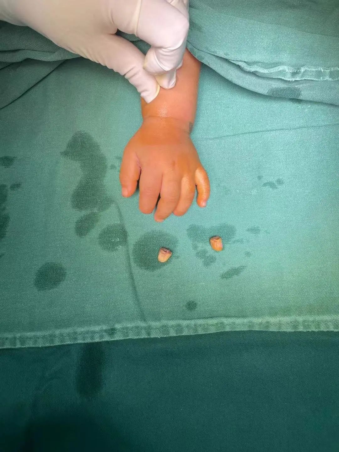 宝宝手指上出现倒刺是在提醒你,该给宝宝多补点水了!