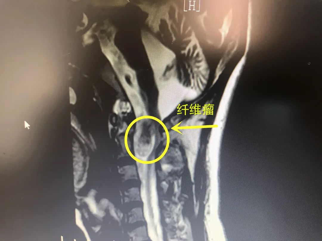 韧带样型纤维瘤病？讨论病例【91360.软组织184】 - 软组织病理 - 91360病理论坛